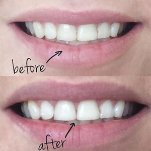 100% Natural Teeth Whitening